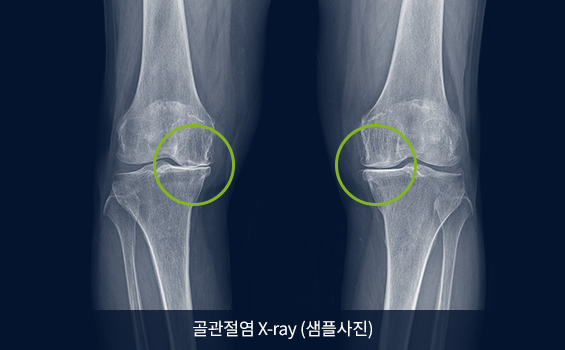 골관절염 X-ray