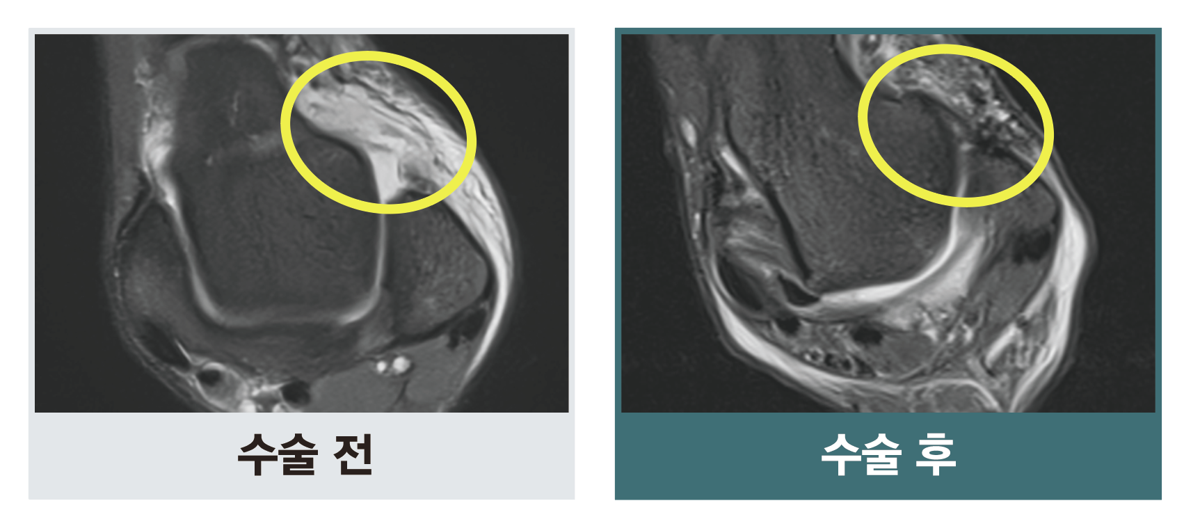 인대 봉합술 전과 후 발목 MRI 비교